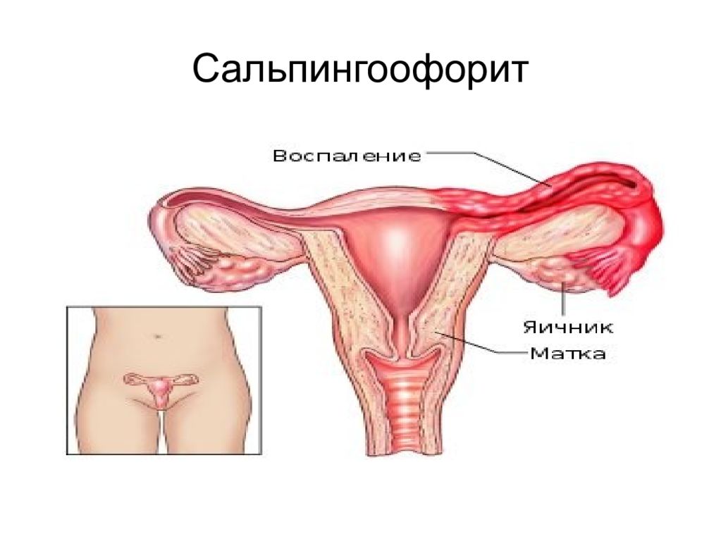 Воспаление органов. Сальпингит и сальпингоофорит. Острый сальпингоофорит и оофорит. Второй этап. Послеродовой сальпингоофорит. Хронический сальпингоофорит симптомы.