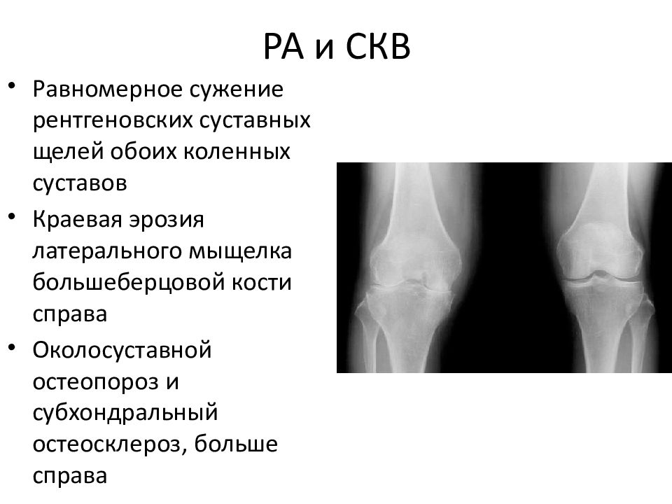 Склероз суставов