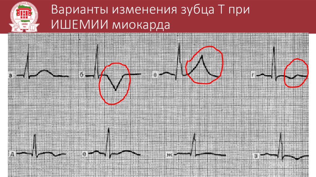 Варианты изменения. Коронарный зубец т на ЭКГ. Изменения зубца т на ЭКГ. Патология зубца т. Зубец т при ишемии миокарда.