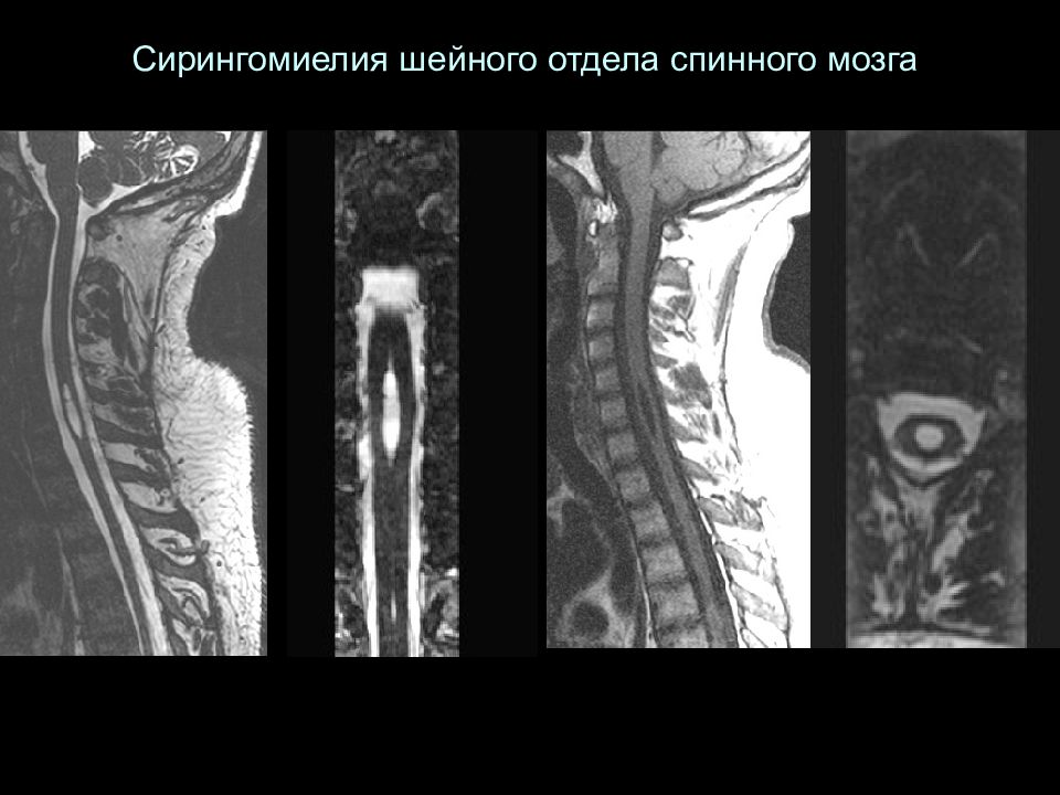 Сирингомиелия презентация по неврологии