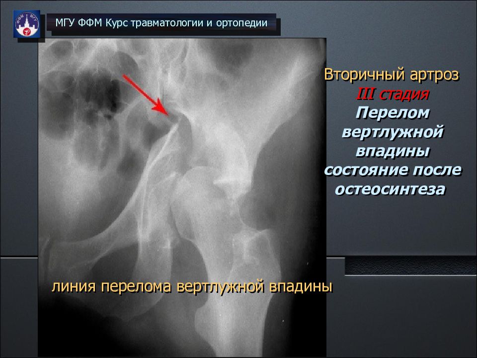 Перелом кости вертлужной впадины