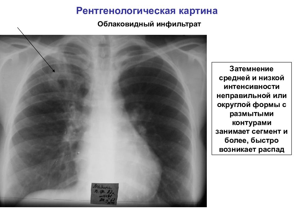 Туберкулез легких карта вызова