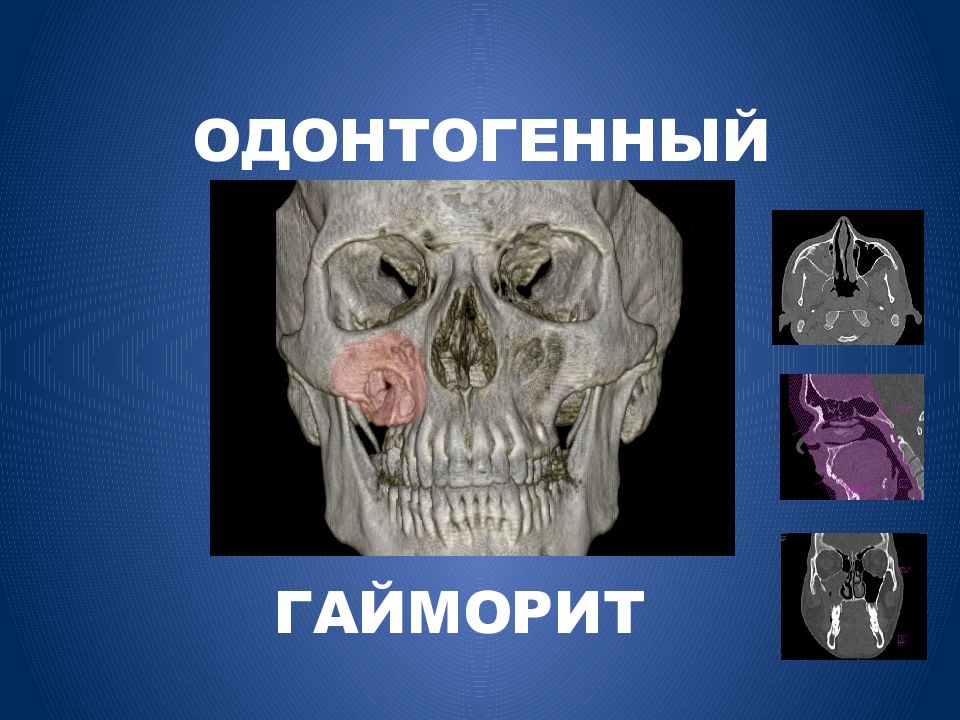 ОДОНТОГЕННЫЙ ГАЙМОРИТ