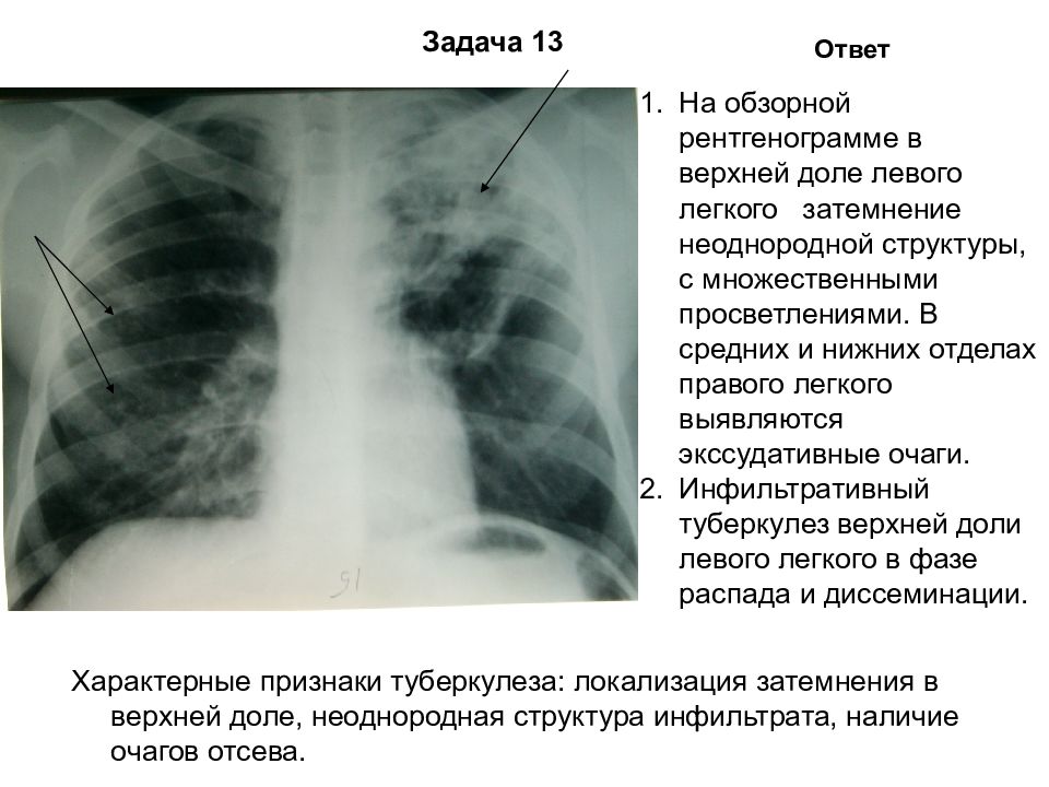 Негативное изображение рентген