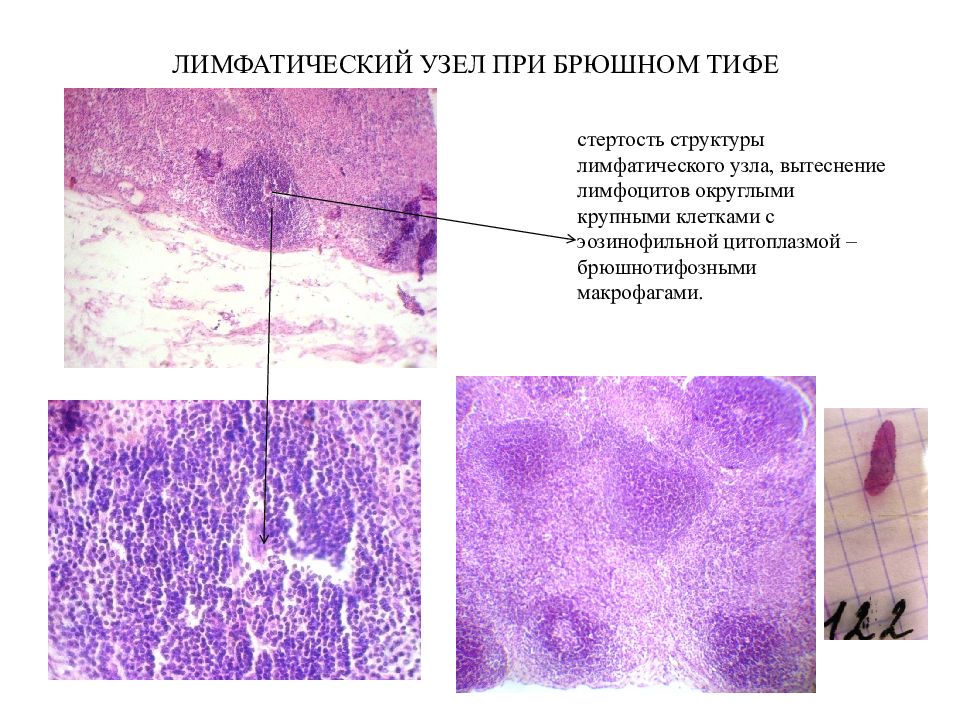 Микропрепарат лимфатический узел. Гистиоцитоз лимфатических узлов гистология. Гранулема при брюшном тифе микропрепарат. Брюшной тиф стадия некроза микропрепарат. Мезентериальный лимфатический узел при брюшном тифе.