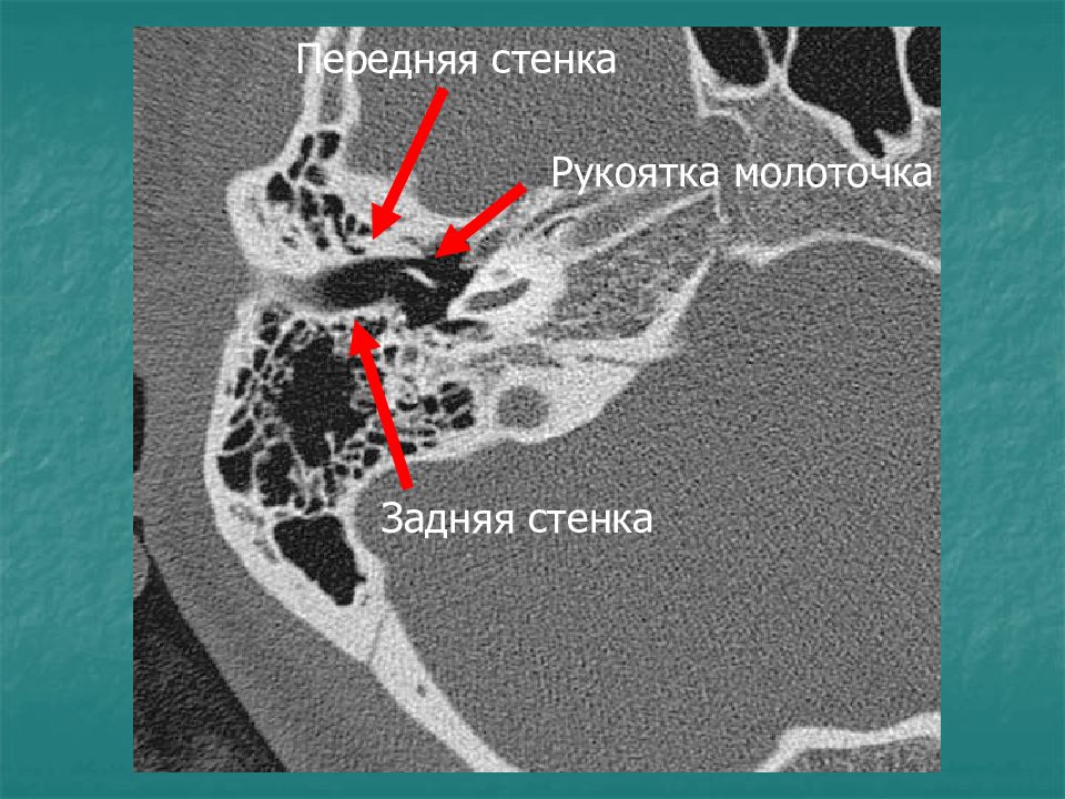 Стенки сосцевидного отростка