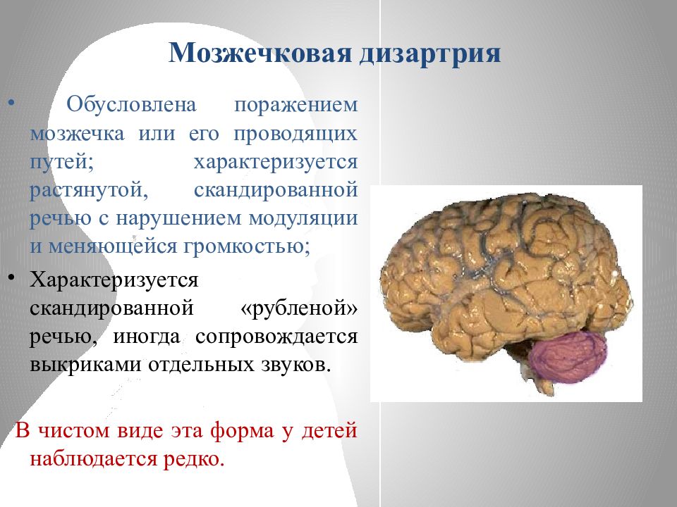 Мозжечковая дизартрия презентация