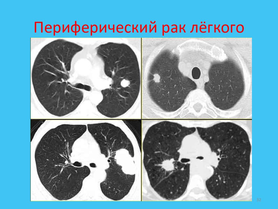 Центральный рак кт. Периферическая карцинома легких кт.