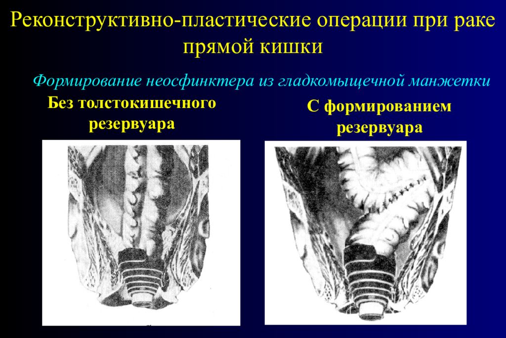 Операция На Прямой Кишке Фото