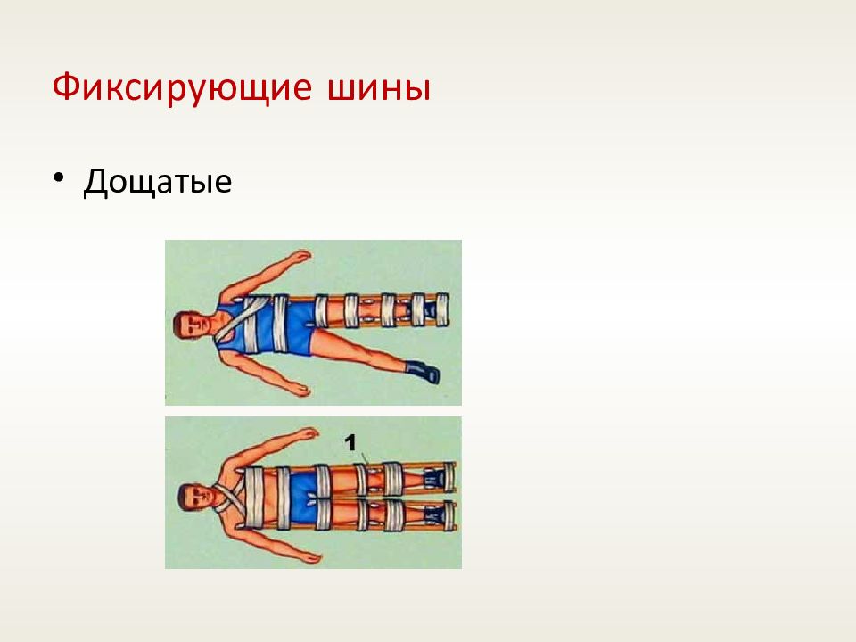 Десмургия иммобилизация. Шины транспортные иммобилизационные. Шины для транспортной иммобилизации. Шина Еланского используется для иммобилизации. Деревянные шины для иммобилизации.