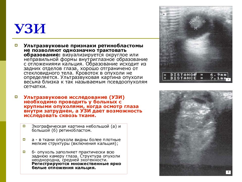 Узи глаз ребенку. Опухоль Вильмса УЗИ признаки. Ультразвуковые признаки. УЗИ глаза новообразование.