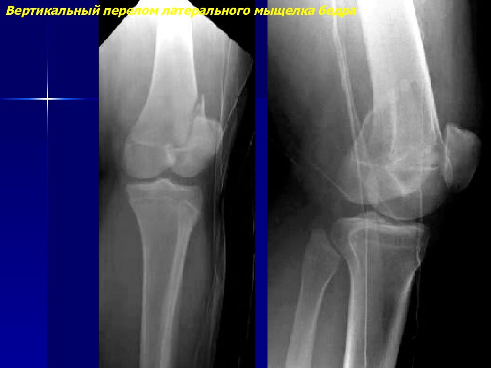 Разрыв кости. Рентгенодиагностика травматических повреждений костей. Двойной вертикальный перелом это. Разрыв главного сустава 3 степени.