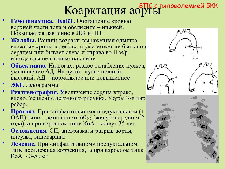 Коарктация аорты презентация