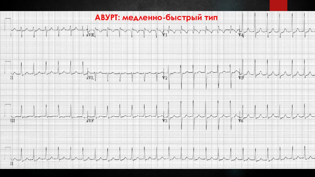 Быстрого типа. АВУРТ на ЭКГ. АВУРТ тахикардия ЭКГ. АВУРТ кардиология. Атипичная АВУРТ.