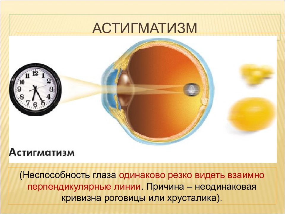 Сложный гиперметропический астигматизм глаз. Астигматизм. Гиперметропический астигматизм. Сложный гиперметропический астигматизм. Оптическая система глаза.