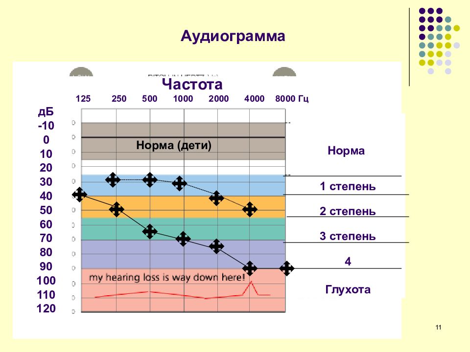 Аудиограмма в норме рисунок