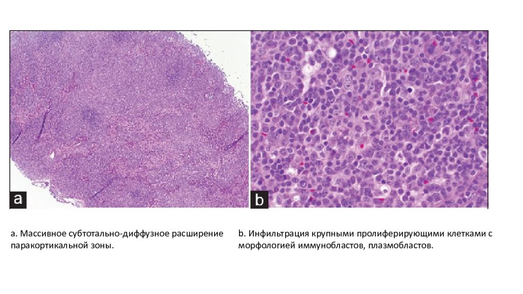 Диффузный токсический зоб (базедова болезнь). Дифузионный тосический зоб. Многоузловой зоб 1 степени щитовидной железы. Лекарства при эндемическом зобе. Диффузный зоб актуальность.