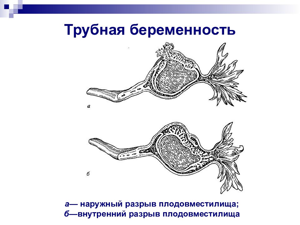 Внематочная беременность картинки для презентации