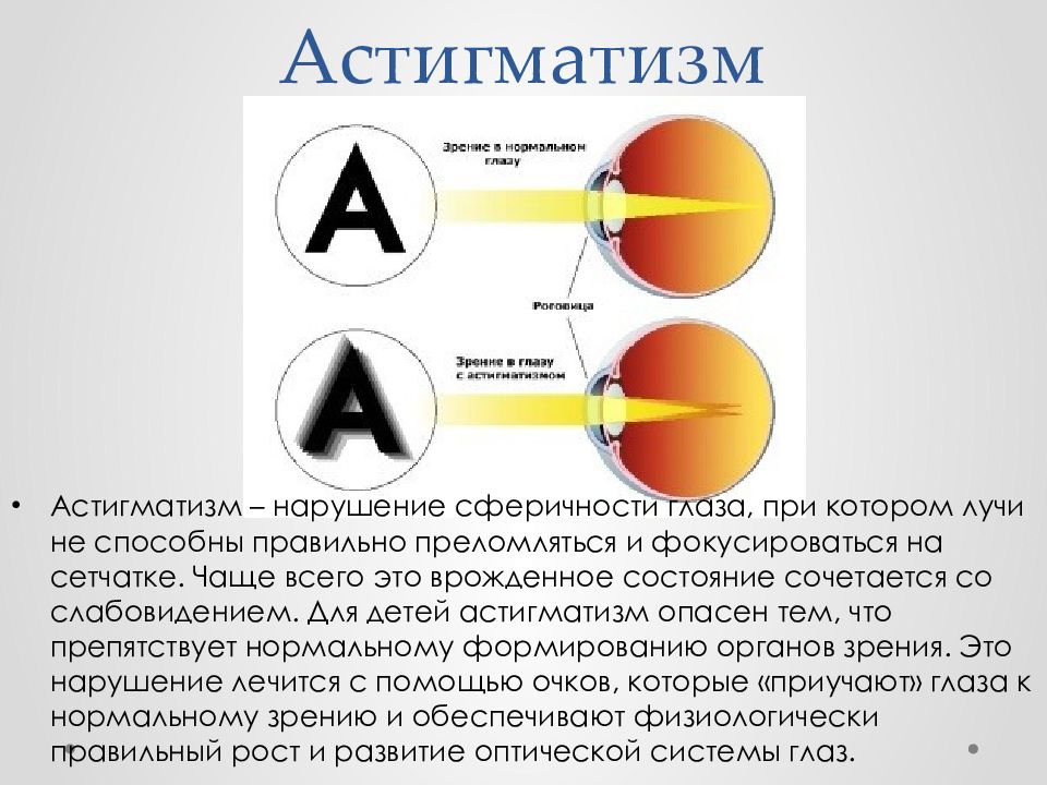 Астигматизм лечение. Астигматизм. Астигматизм у детей. Астигматизм профилактика. Заболевание зрения астигматизм.