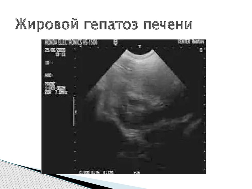 Диффузные изменения печени жировой гепатоз что это. Жировой гепатоз печени на УЗИ. УЗИ признаки жирового гепатоза.