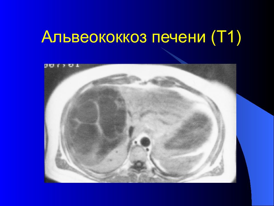 Поражение печени альвеококком схема