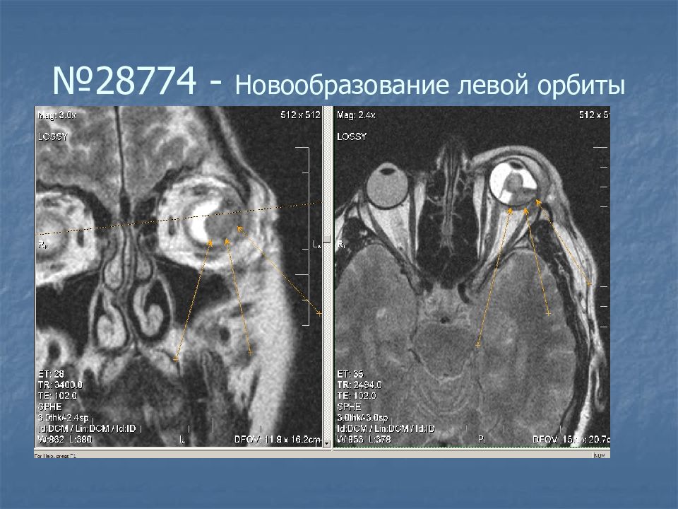 Опухоль левой. Первичные доброкачественные опухоли орбиты. Методы диагностики опухолей орбиты.