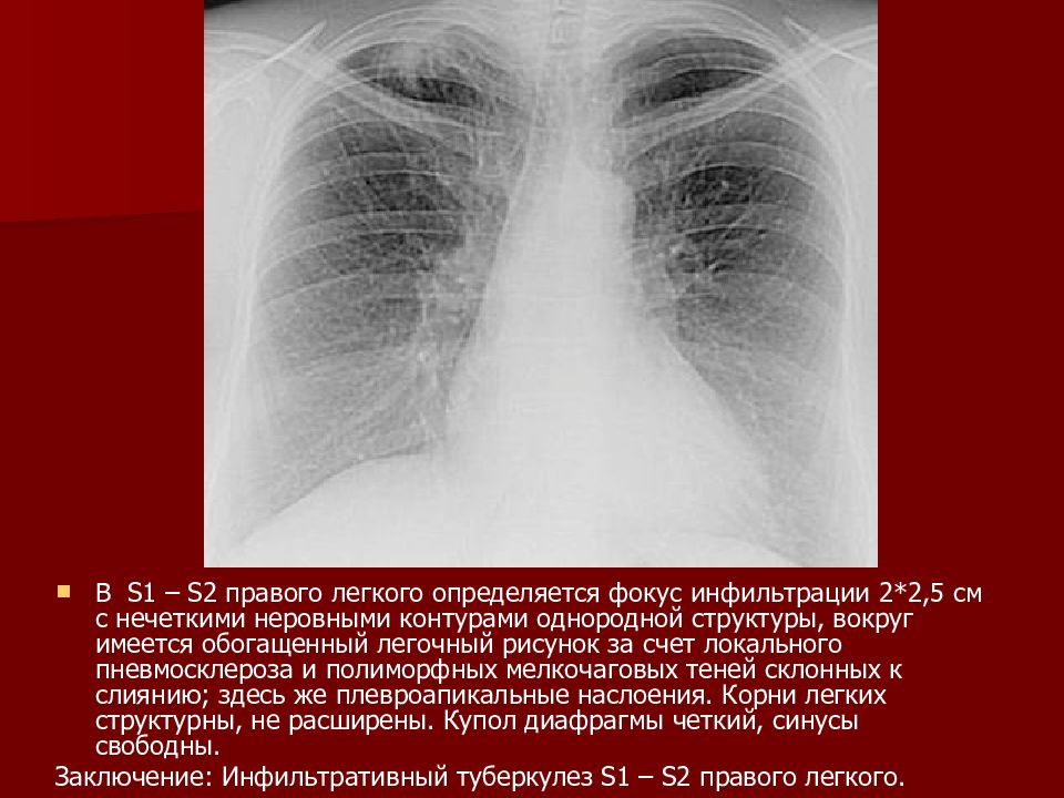 Легочный рисунок усилен и обогащен