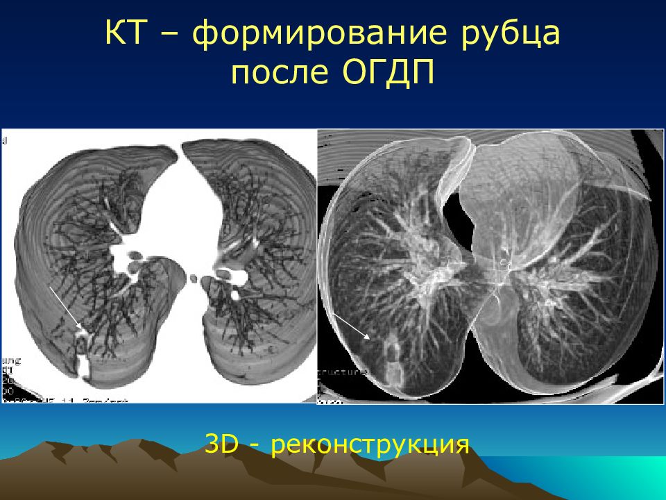 Острая гнойная деструктивная пневмония у детей презентация