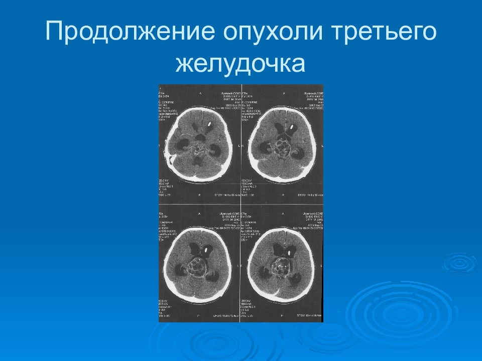 Опухоль 3 типа. Объемные образования ЦНС. Экстрадуральные опухоли.