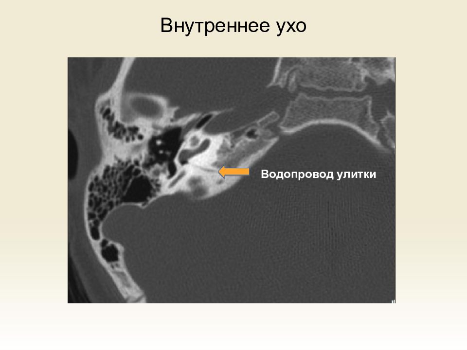 Средний отит кт картина