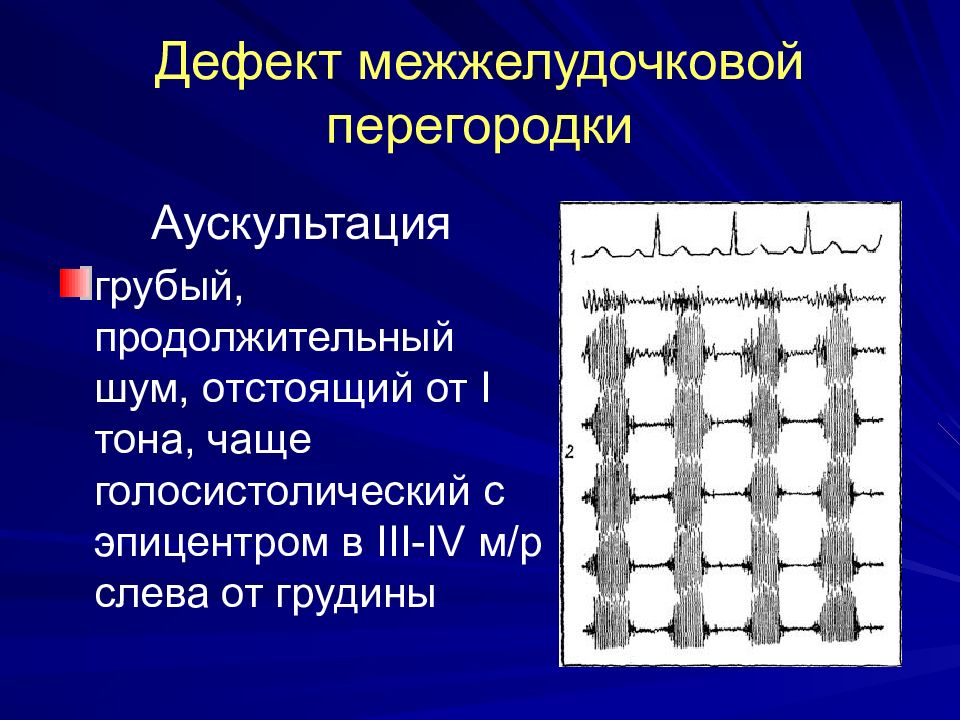 Дефекты перегородок. Дефект межжелудочковой перегородки аускультация. Дефект межжелудочковой перегородки Ауск. ДМЖП аускультация. Аускультация при дефекте межжелудочковой перегородки.