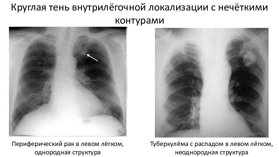 Презентация туберкулема легких