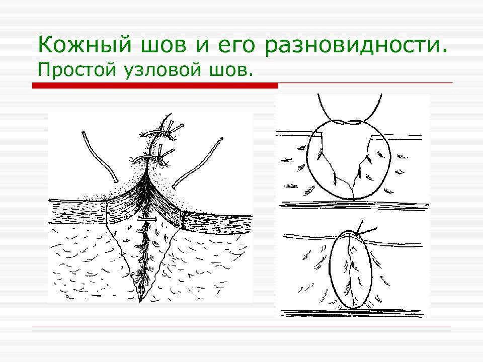 Хирургические швы. Узловатый хирургический шов. Узловатый простой хирургический шов.