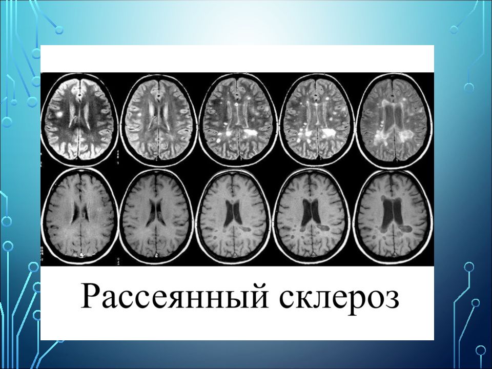 Презентация на тему рассеянный склероз