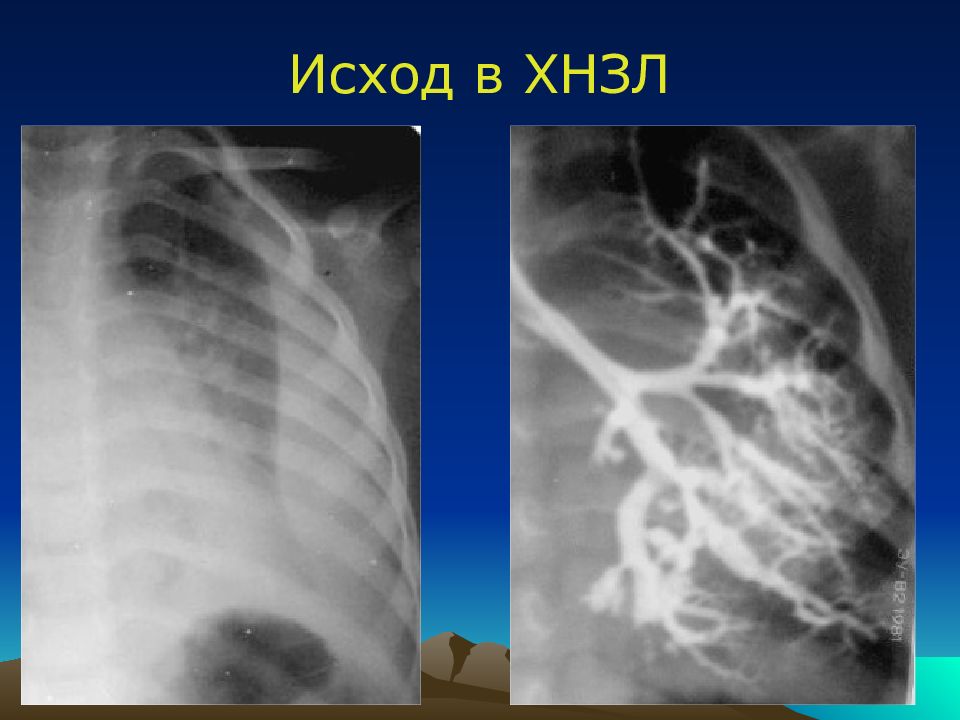 Острая гнойная деструктивная пневмония у детей презентация