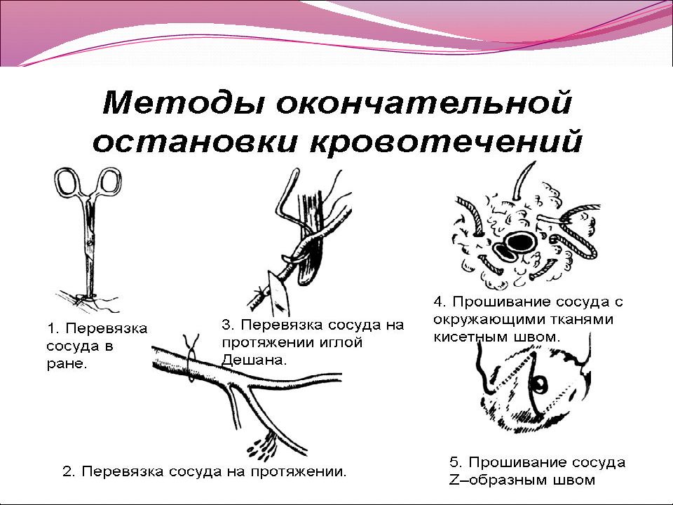 Окончательное кровотечение. Методы окончательной остановки кровотечения. Физические способы окончательной остановки кровотечения. Механические методы окончательной остановки кровотечения. Способы окончательной остановки кровотечения в ране.