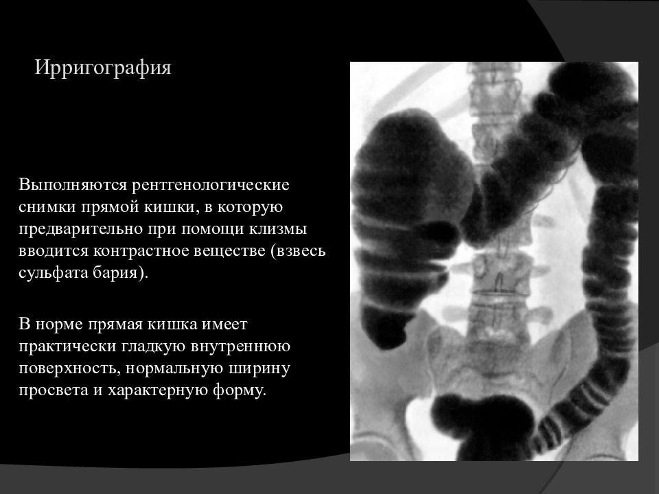 Ирригография кишечника. Рентген толстой кишки норма. Ирригоскопия рентген норма. Описание рентгенограммы сигмовидной кишки. Рентген прямой кишки в норме.