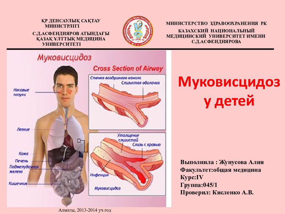 Муковисцидоз у детей Алматы, 2013-2014 уч.год ҚР ДЕНСАУЛЫҚ САҚТАУ