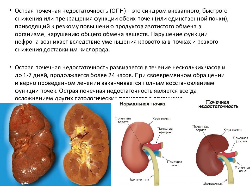 Почечная недостаточность клиническая картина