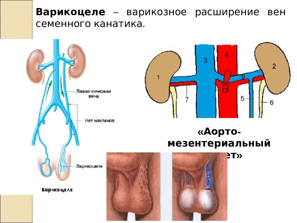 Варикоцеле у детей презентация