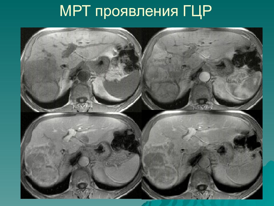 Очаговые заболевания печени презентация