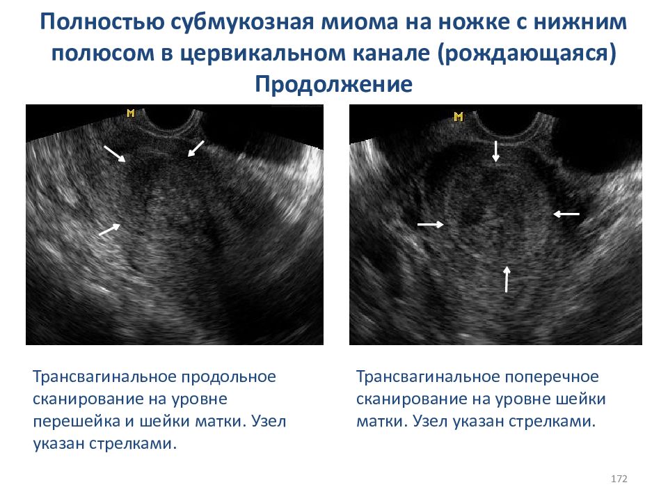 Размер миомы для операции. . Гистероскопия (субмукозные узлы).. УЗИ признаки субмукозного узла.