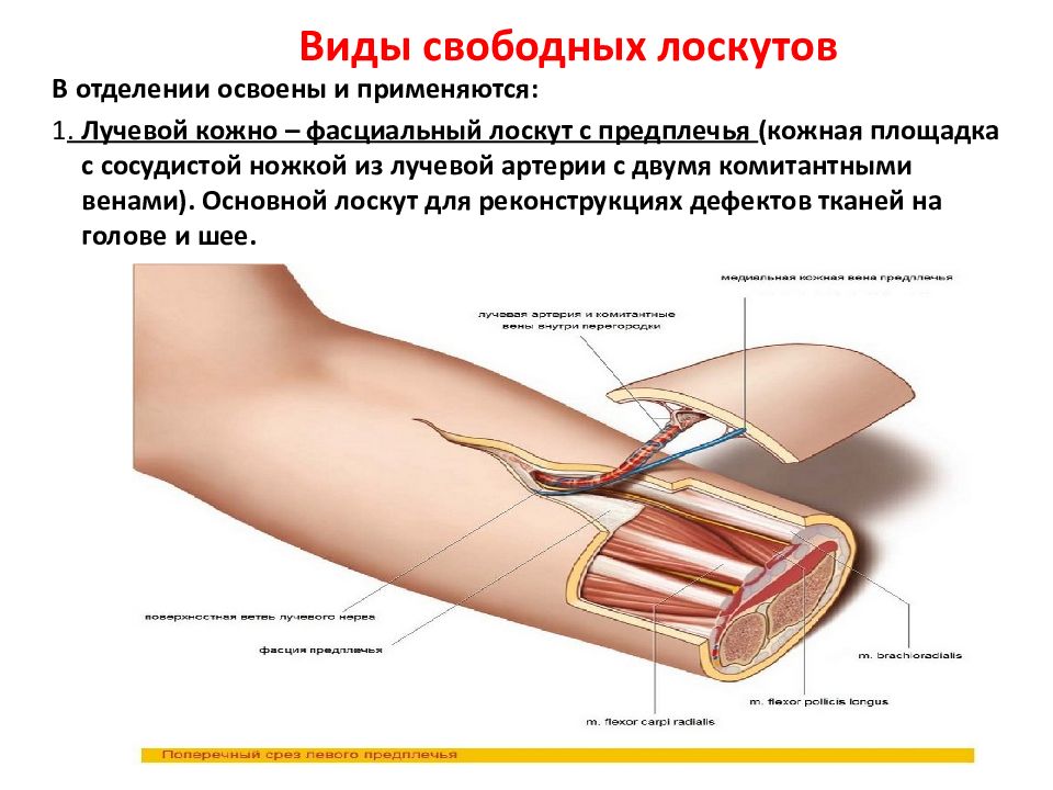 Свободный лоскут. Кожно фасциальный лоскут.