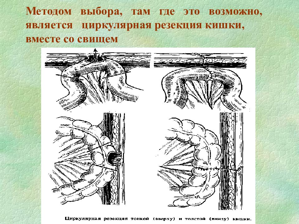 Свищи хирургия презентация