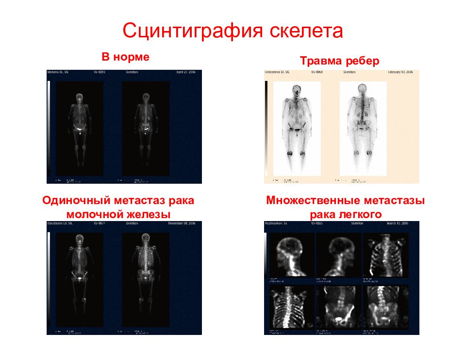 Сцинтиграфия костей скелета. Сцинтиграфия костей метастазы РМЖ. Сцинтиграфия костей норма. Радионуклидная диагностика в онкологии костей скелета. Остеосцинтиграфия костей скелета норма.