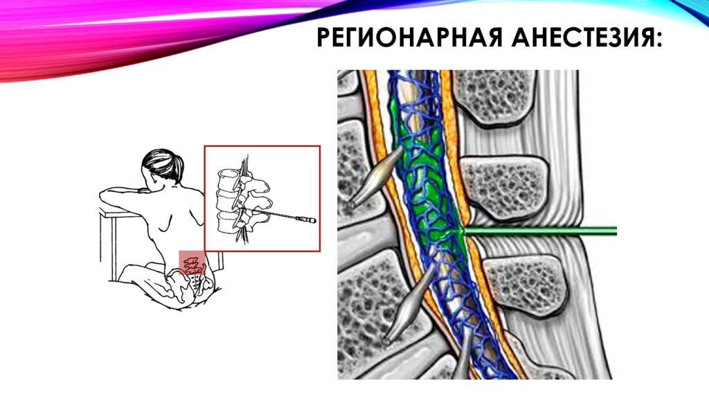 Регионарная анестезия презентация