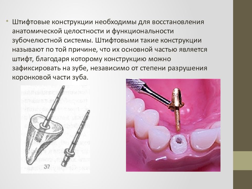 Штифтовые конструкции в ортопедической стоматологии презентация