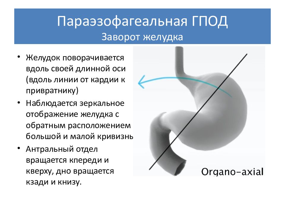 Схема лечения грыжи пищеводного отверстия диафрагмы