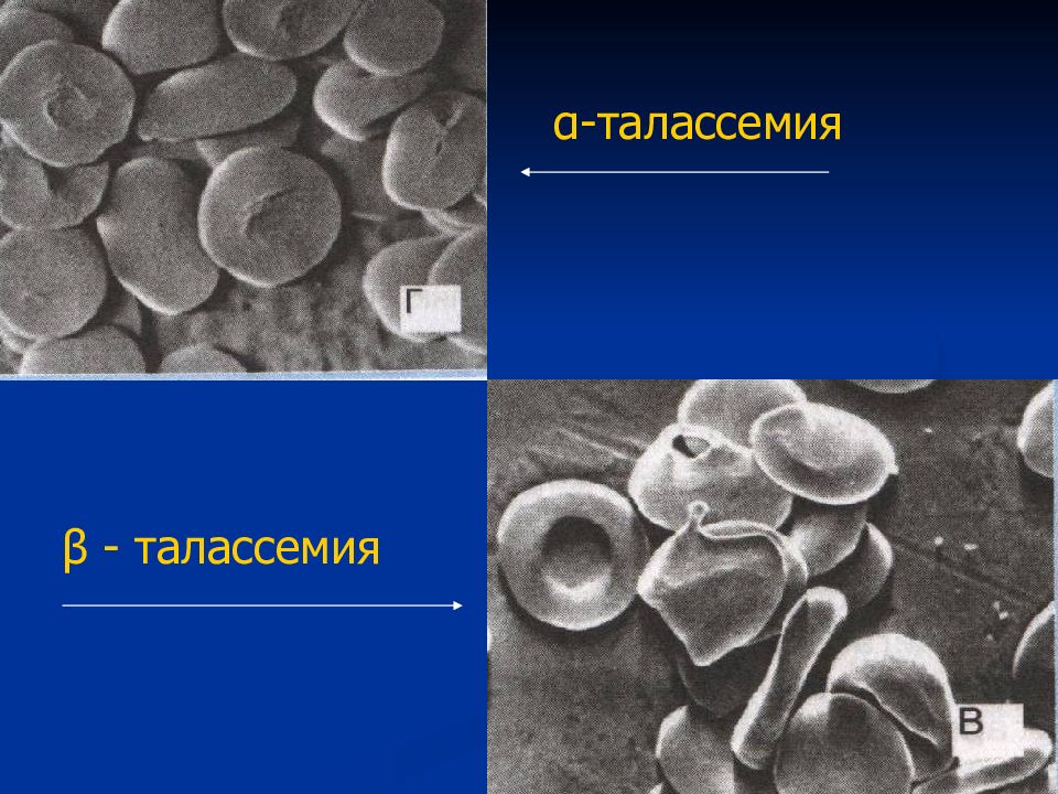 Талассемия презентация по генетике