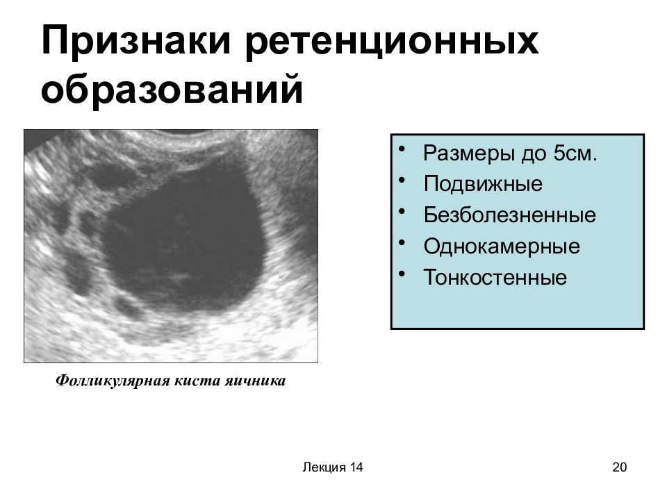 Неоднородные яичники. Ретенционная киста яичника. Ретенционные образования яичников. Ретенционная киста яичника на УЗИ. Кисты яичников ретенционные образования.